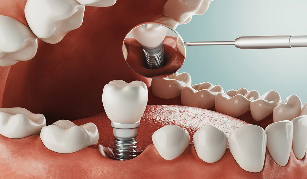 implants 3